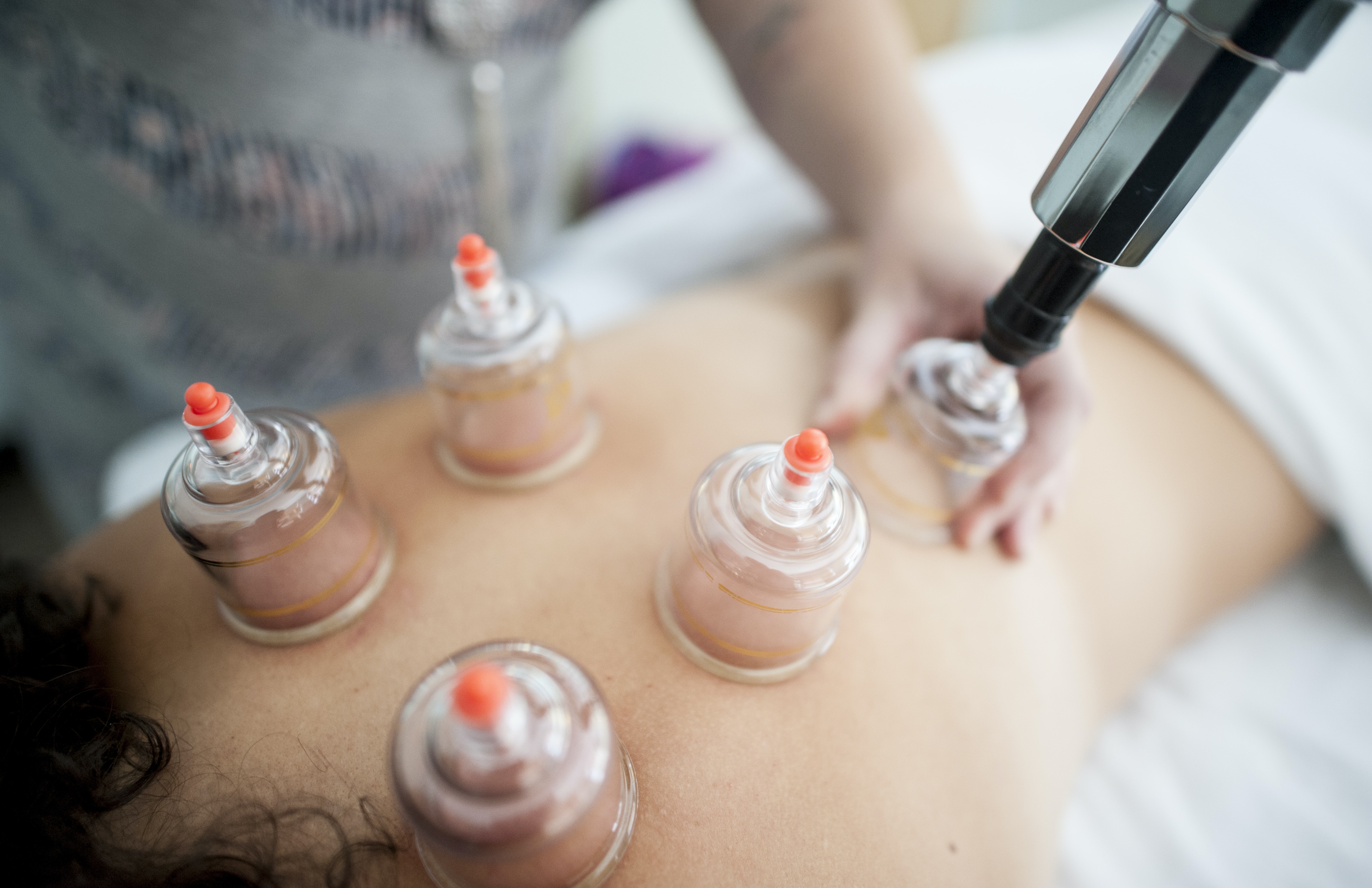 Hijama cupping