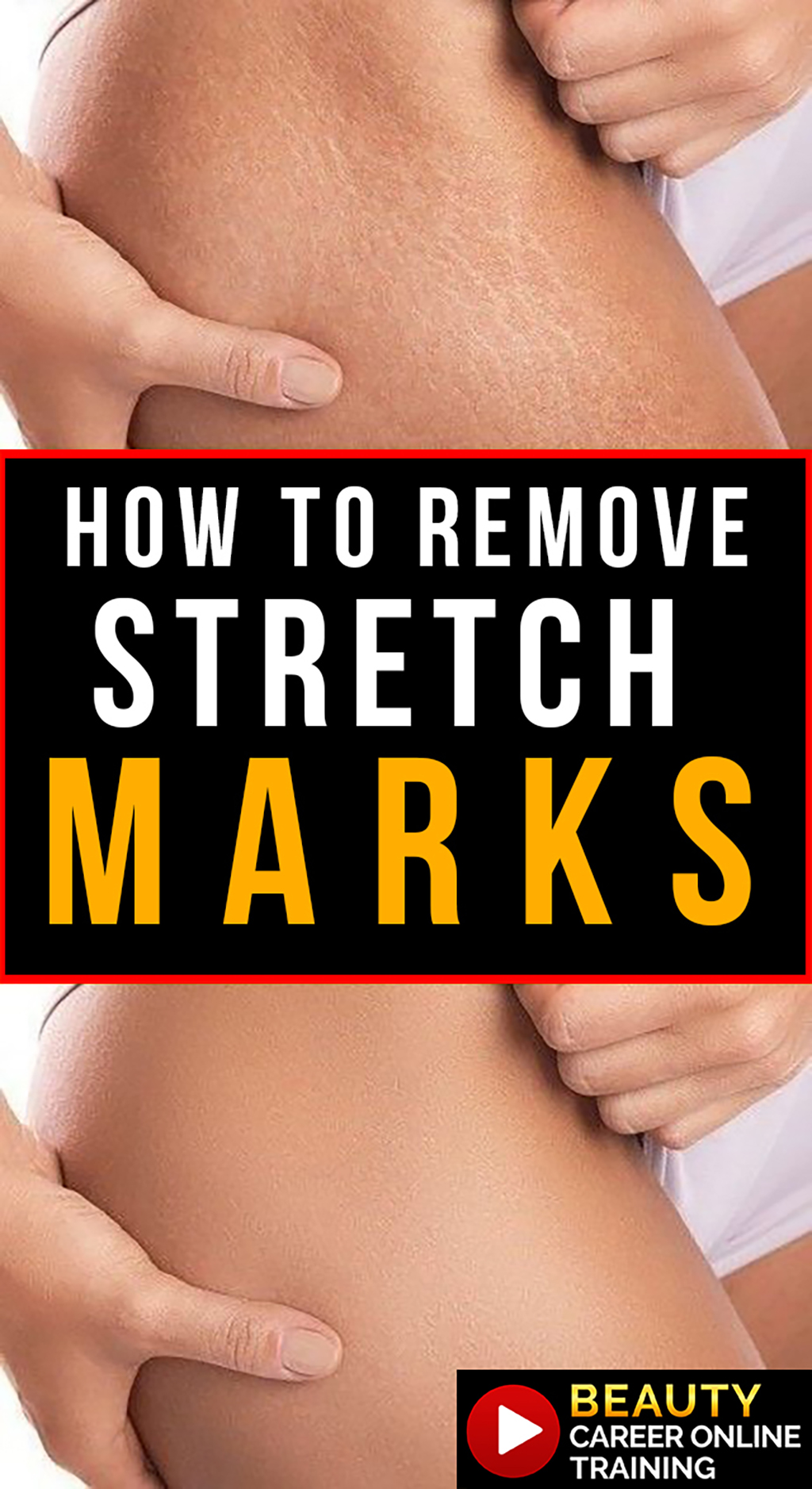 How to remove stretch marks, Diminish stretch marks, pregnancy stretch marks, weight loss stretch marks, weight gain stretch marks