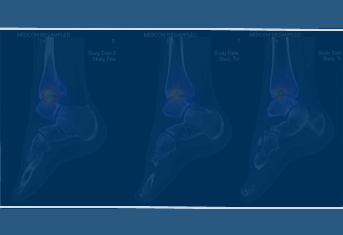 Reconstruction of Ankle & Hindfoot Deformities