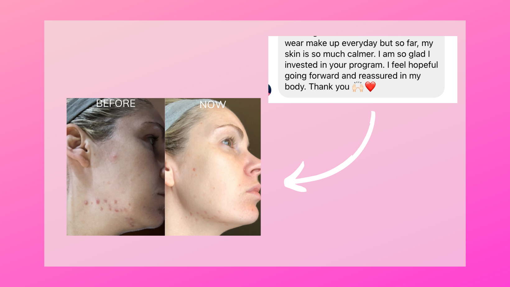 acne treatment testimonial