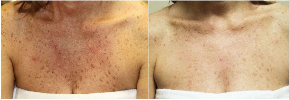 Remove age spots sunspots acne dark spots