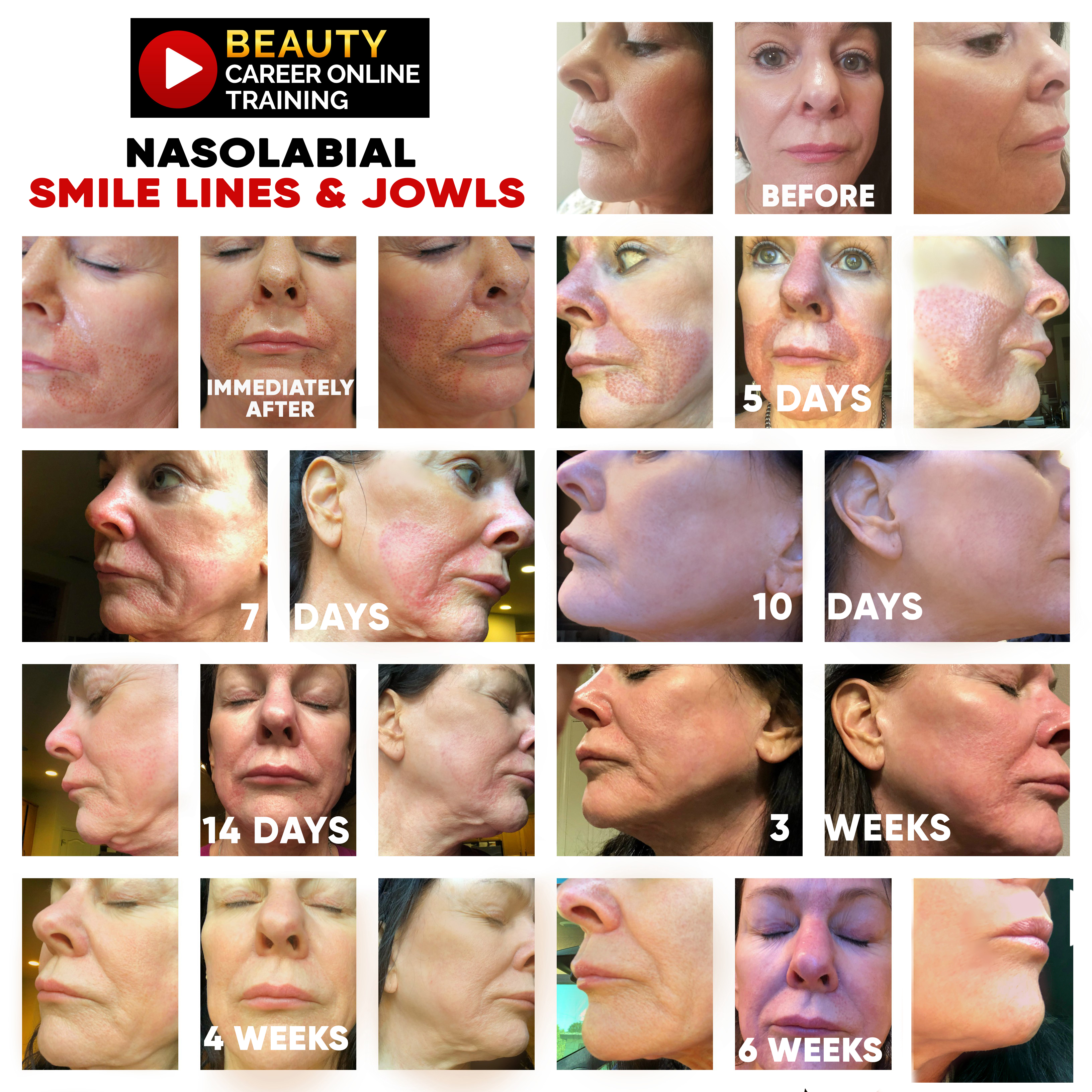 what are jowls, marionette lines, how to get rid of jowls, tighten jowls, ultherapy, plasma pen lift, plasma pen, firoblast plasma, plasma fibroblast, sagging jowls, jowls treatment, jowls face, sagging jowls botox, sagging jawline. jowls in 20s, best procedure for sagging jowls 2020, 2021, laser treatment for sagging jowls 