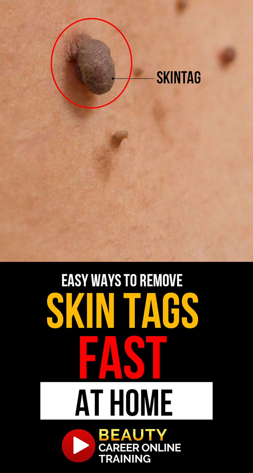 skin tag are painless, noncancerous growths on the skin, skin tag removal, DIY skin tag removal, Skin tag removal online training, plasma pen skin tag removal, plasma pen training, fibroblast plasma online training, skin growth, skin