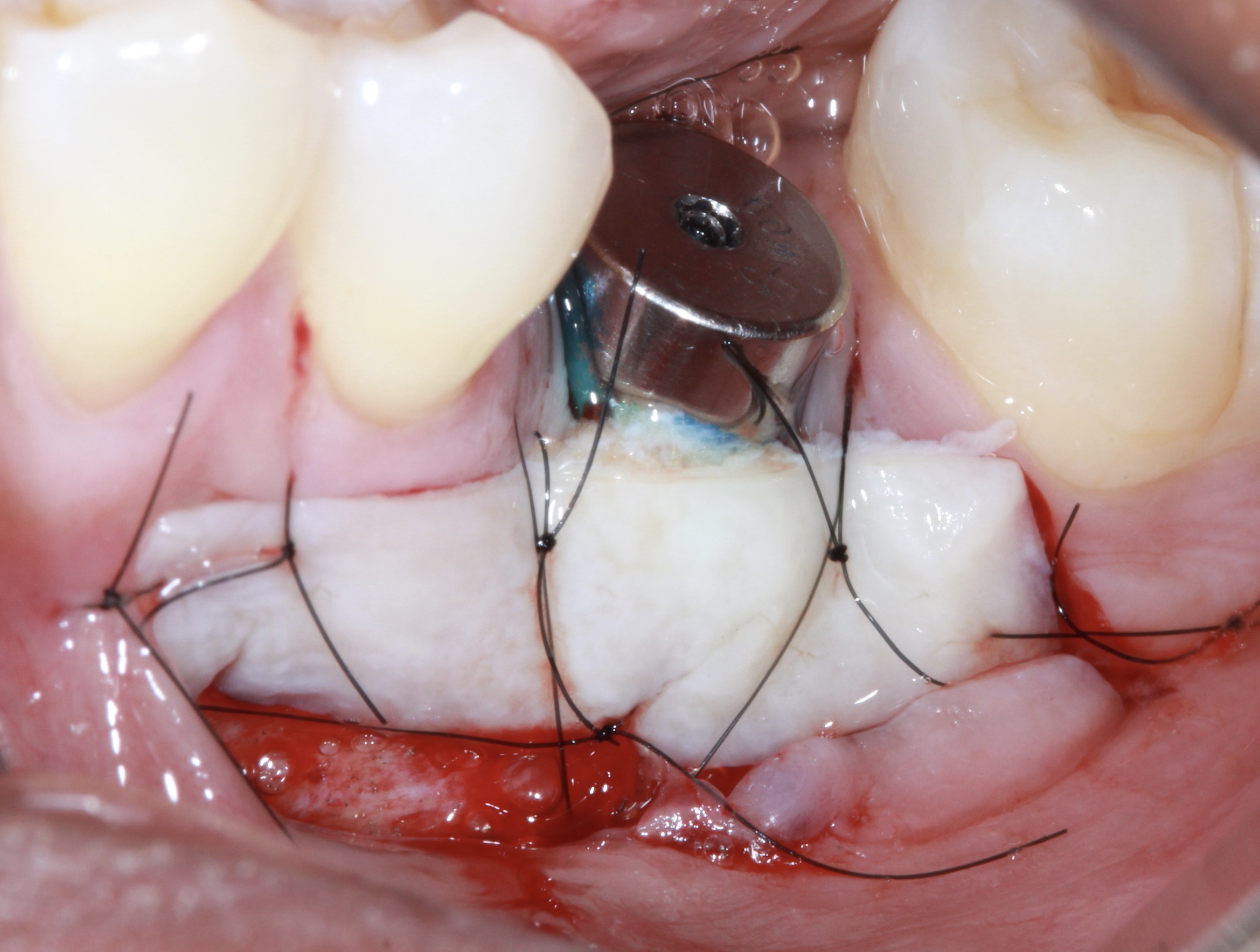 soft tissue grafting course