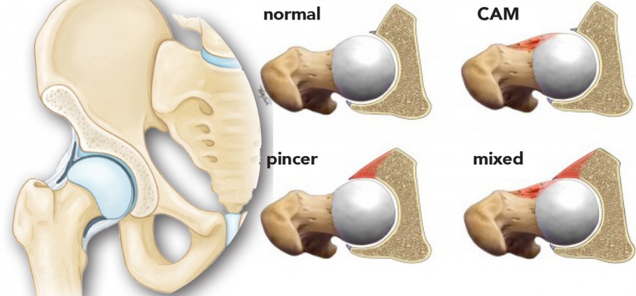 Image: Types of FAI diagram.