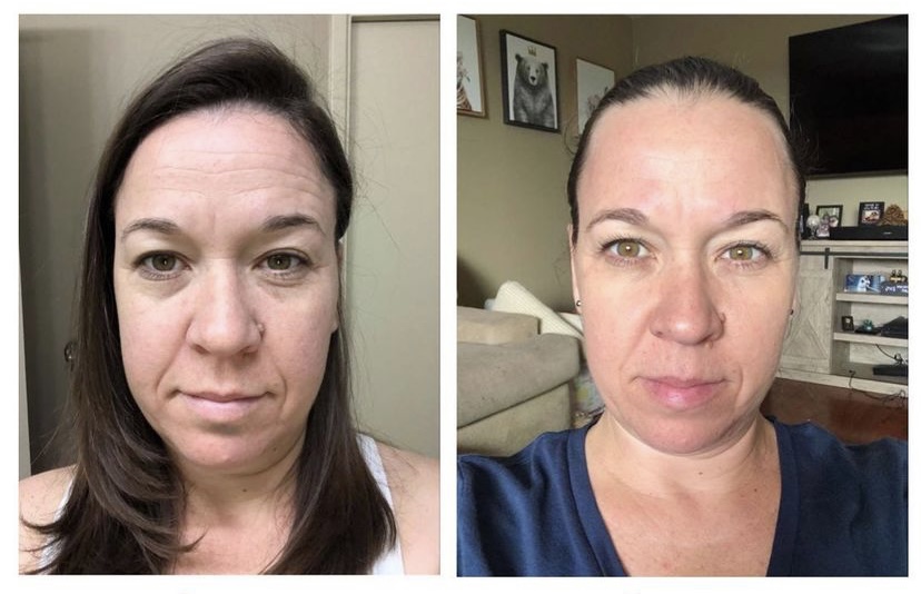 1 week forehead transformation with face yoga