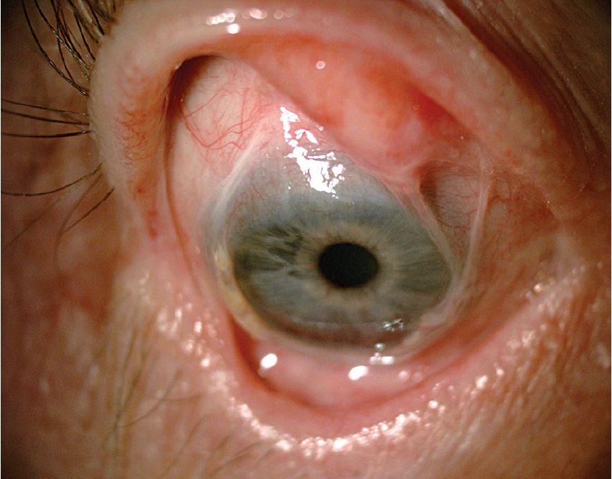 60142 - Progressive Conjunctival Scarring